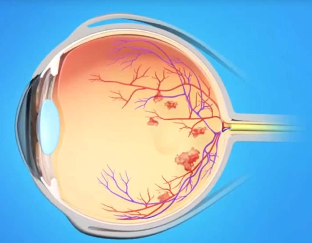 a-high-risk-for-diabetes-means-a-high-risk-for-blindness-hawaiian-eye