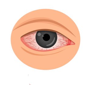 Eye irritation. konyuktevitis, keratitis, allergies, uveitis.