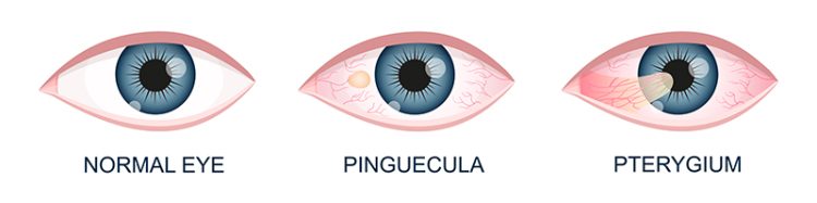 Eye healthy, with pinguecula and pterygium growing onto cornea. Conjunctival degeneration. Eye disease. Human organ of vision with pathology. Vector realistic illustration.