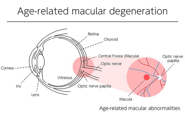 Illustration of eye disease, age-related macular degeneration