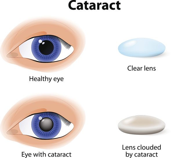 cataract is an clouding crystalline lens inside the eye.