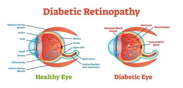 Diabetic Retinopathy vector illustration diagram, anatomical scheme. Medical educational information.